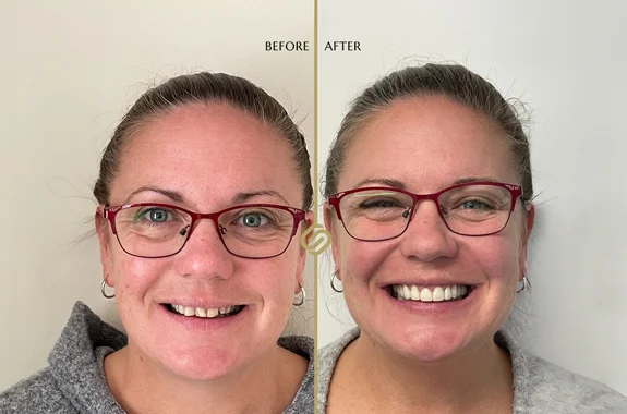 Free Smile Makeover Consultations